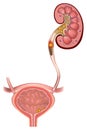 stones in the kidneys. Urolithiasis disease.